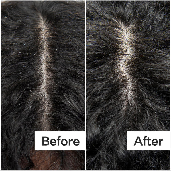Before/After of scalp when using Act+Acre Vitamin E Scalp Detox Oil