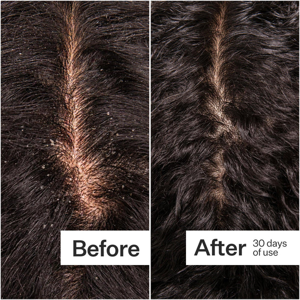 Before/After of scalp when using Act+Acre Microbiome Cooling Scalp Serum