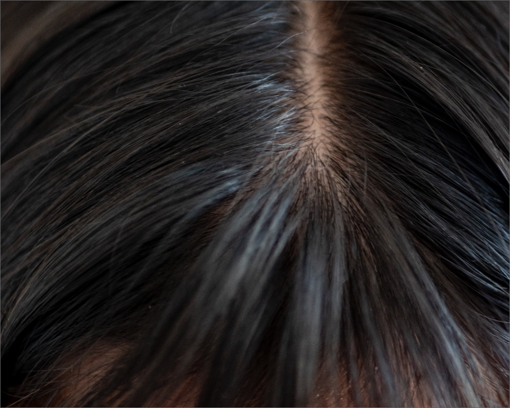 Why is Scalp Health Important?