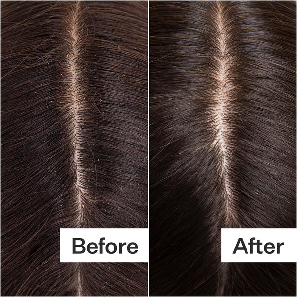 Before/After of scalp health when using Act+Acre Hair Cleanse Shampoo