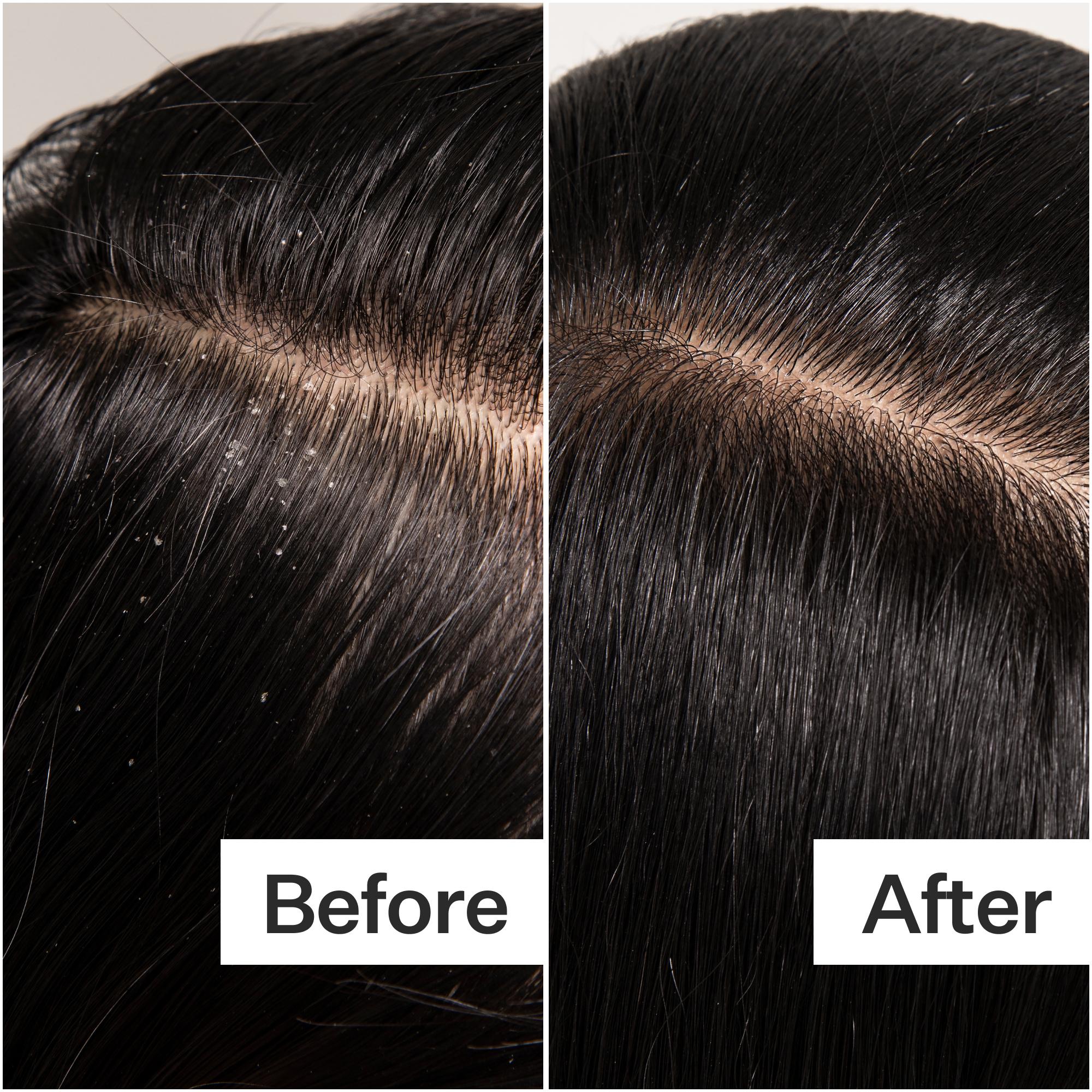 Before/After of scalp when using Act+Acre Vitamin E Scalp Detox Oil