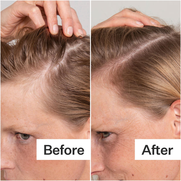 Before/After of scalp when using Act+ Acre BHA Salicylic Acid Scalp Exfoliator