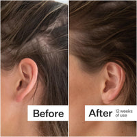 Before/After of hair growth when using Act+Acre Thick + Full Capsules