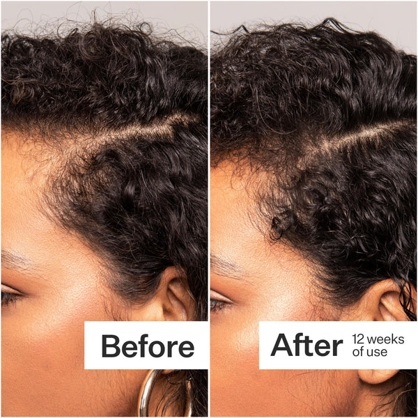 Before/After of hair growth when using Act+Acre Thick + Full Capsules