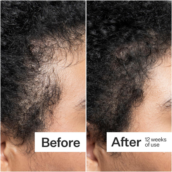 Before/After of hair growth when using 0.25mm Scalp Dermaroller