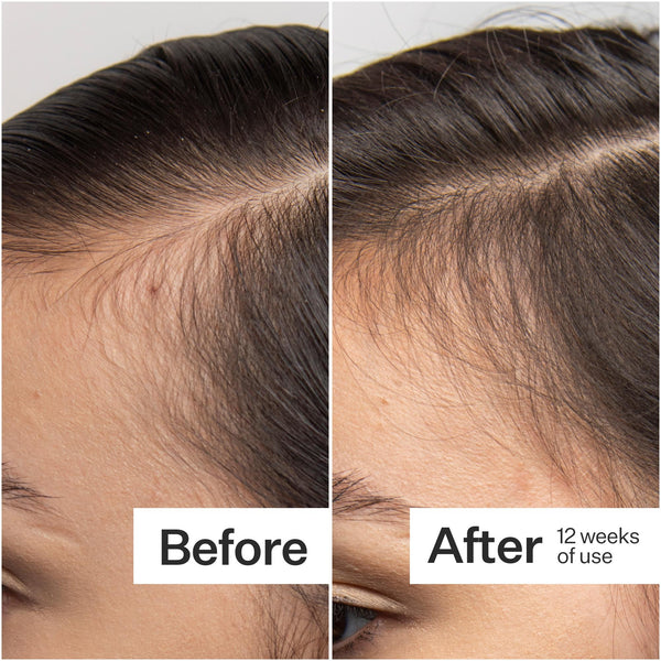 Before/After of hair growth when using 0.25mm Scalp Dermaroller