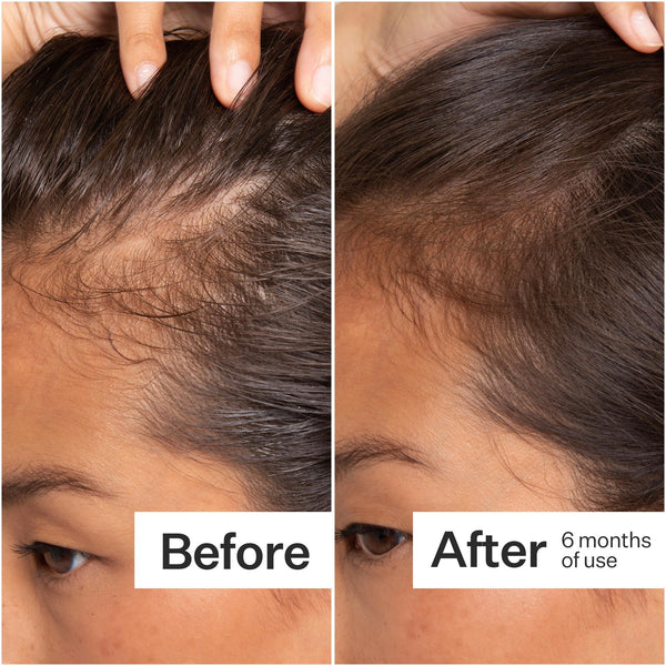 Before/After of hair growth when using Act+Acre Stem Cell Scalp Serum