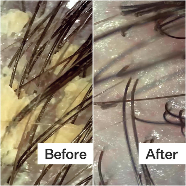 Before/After of scalp after using Act+Acre Scalp Relief System