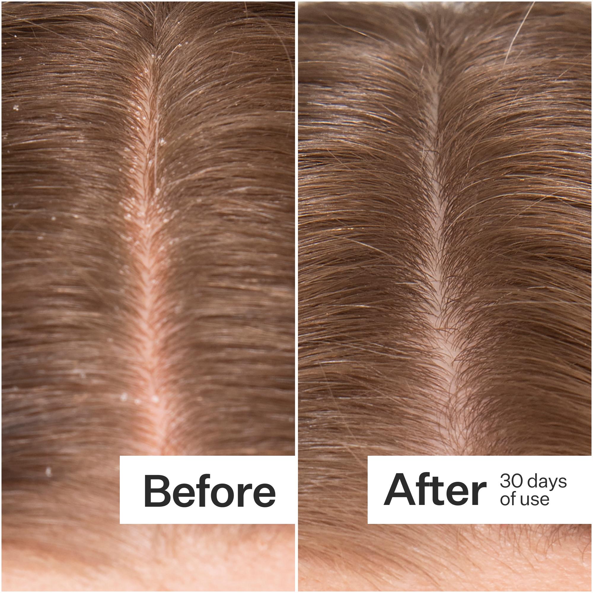 Before/After of scalp when using Act+Acre Microbiome Cooling Scalp Serum