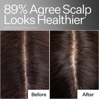 Before/After of scalp health when using Act+Acre Hair Cleanse Shampoo