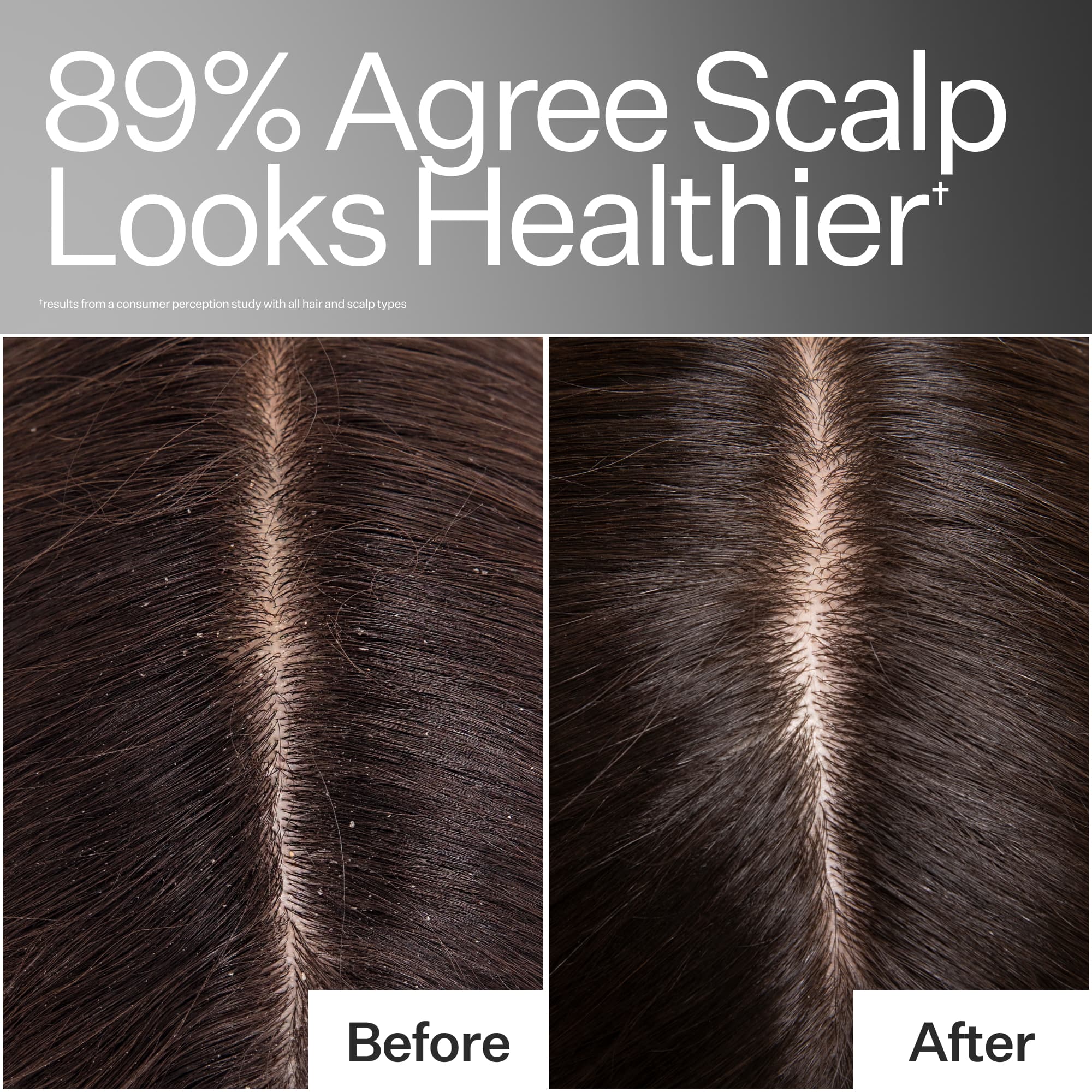 Before/After of scalp health when using Act+Acre Hair Cleanse Shampoo