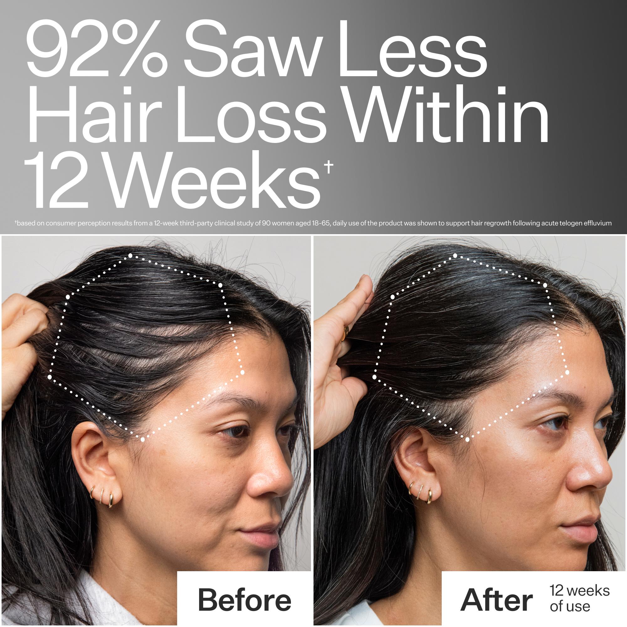 Before and after comparison of hair loss reduction with text indicating results within 12 weeks.