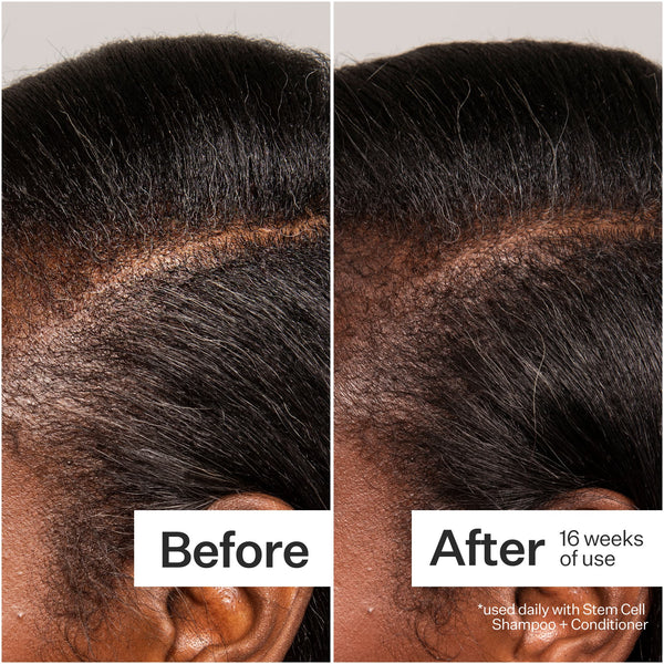 Before/After of hair loss when using Act+Acre 3% Stem Cell Peptide Scalp Treatment