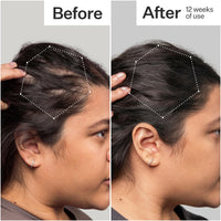Before and after comparison of hair thickness on a person's head, showing an increase in thickness over 12 weeks.