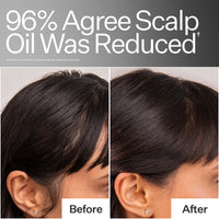 Before / After when using Act+Acre 4% Niacinamide Oily Scalp Serum