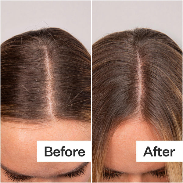 Before/After when using Daily Hydro™ Scalp Serum