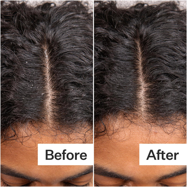 Before/After when using Daily Hydro™ Scalp Serum