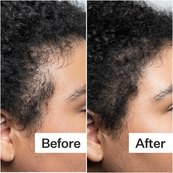 Before/After of hair growth when using Act+Acre Fuller Hair System