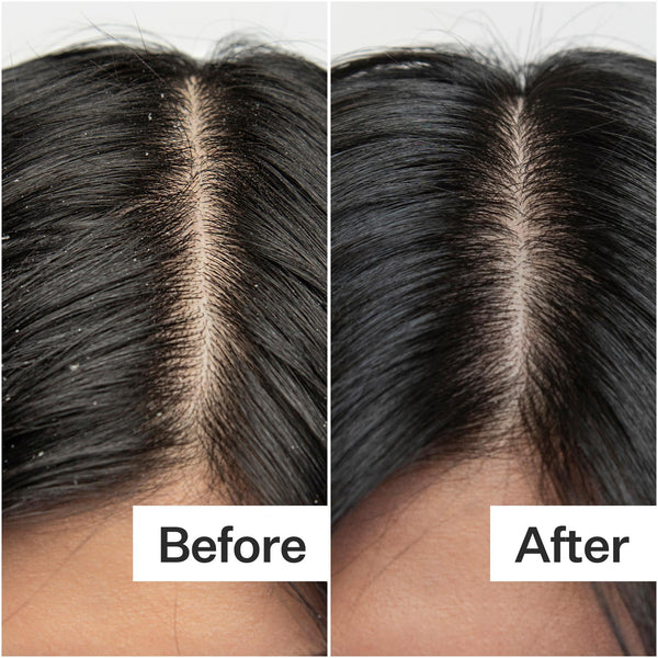 Before/After of scalp health when using Act+Acre Dry + Itchy Scalp System