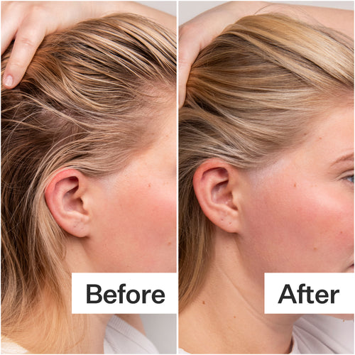Before/After when using Act+Acre 4% Niacinamide Oily Scalp Serum
