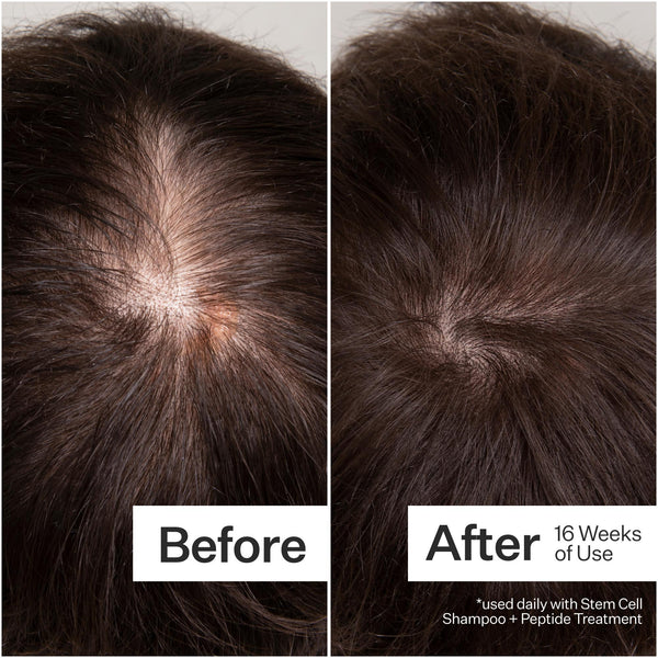 Before/After of hair growth using Act+Acre Stem Cell System