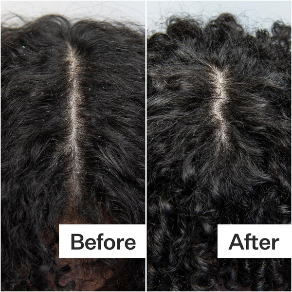 Before/After of scalp when using Act+Acre Scalp Build-Up System