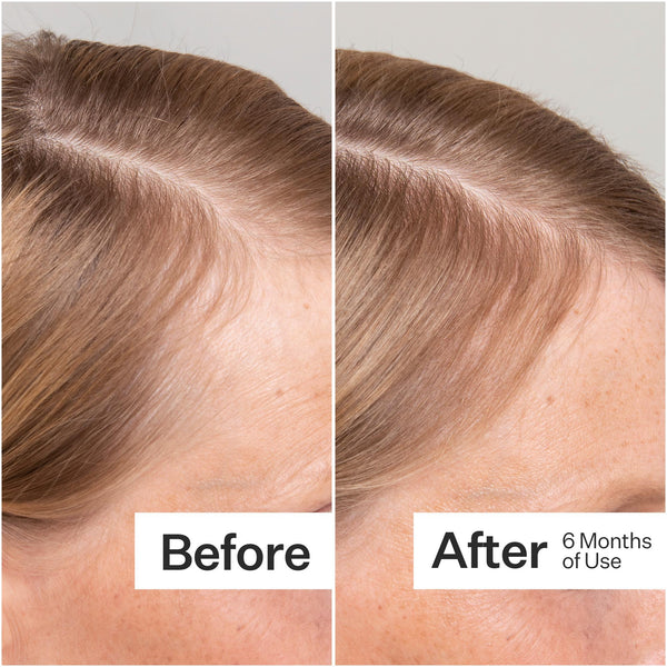 Before/After of hair growth when using Act+Acre Stem Cell Scalp Serum