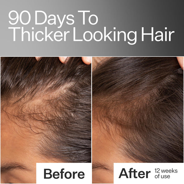 Before/After of improved hair thickness  using Act+Acre Stem Cell Scalp Serum - 3 Pack