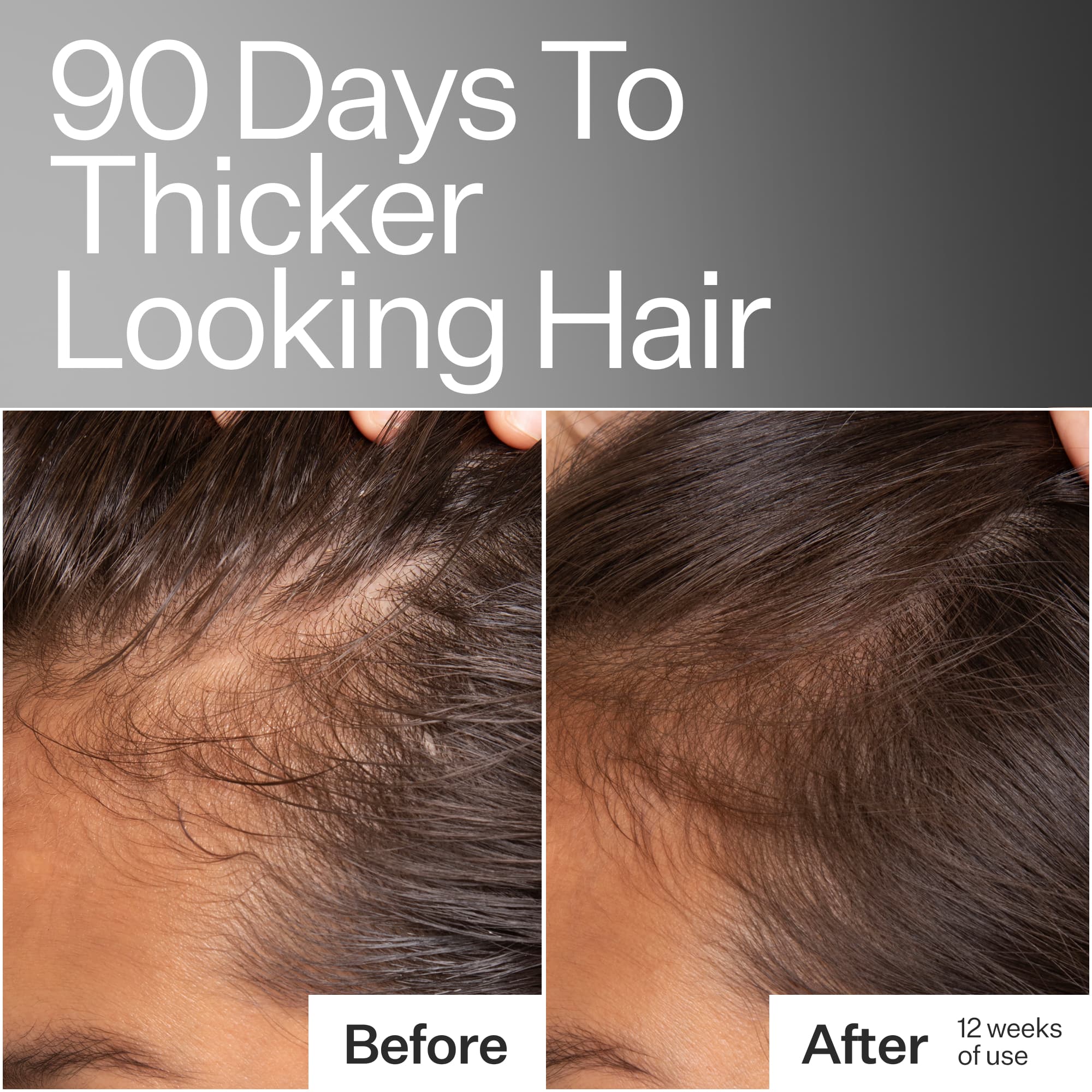 Before and after images of models hairline close up 